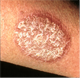 psoriasis_80.png
